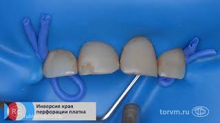 Torvm Clamp 9 Aplication 002 Rubberdamology Rus 4K