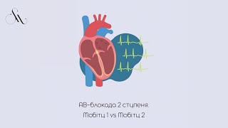 АВ-блокада 2 ступеня. Мобітц 1 vs Мобітц 2