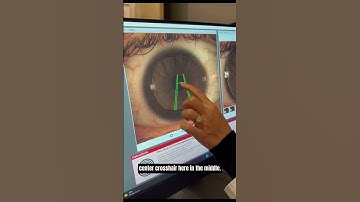 Corneal Topography Demonstration