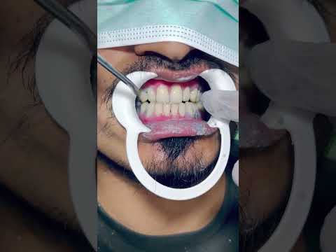 Teeth whitening powder