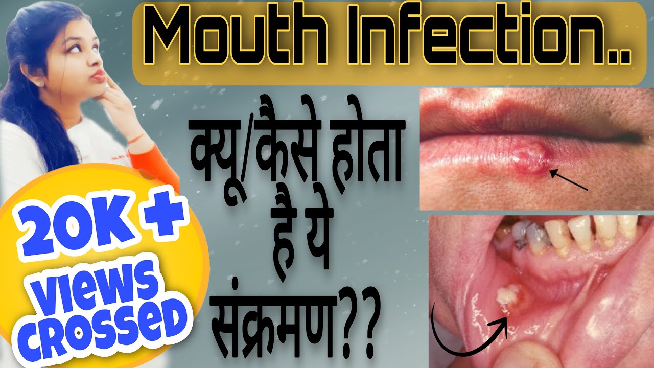 What is Mouth Infection?Oral Infection Causes Symptoms Conditions
