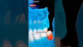 How to Tooth Extraction Process (3D Animation)#toothextraction#toothextractionsurgery