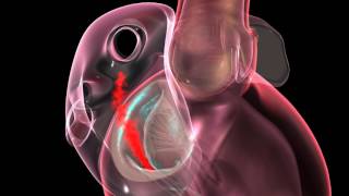 What a Heart Murmur Looks Like in the Body