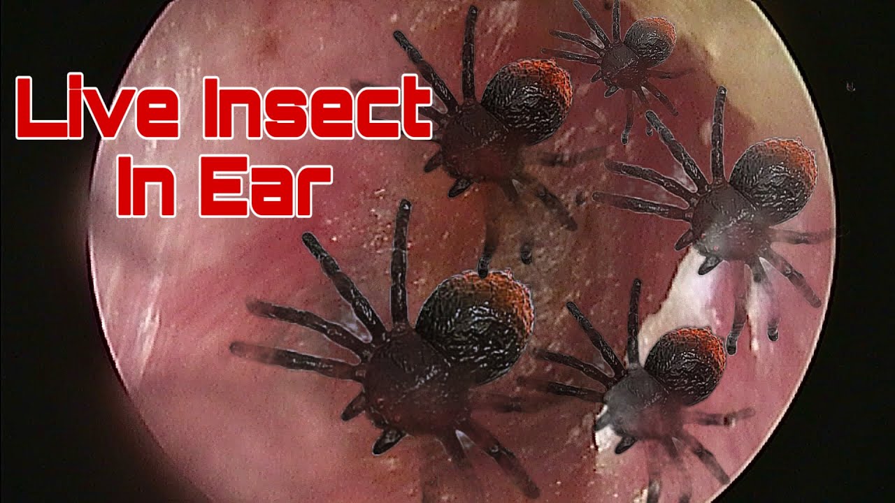 Live Insects Nest In Ear Removal | Doctor Anh - YouTube