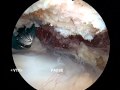 Shoulder Arthroscopic Subacromial Decompression - Dr. Tony Jabbour
