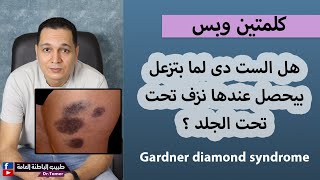 الست لما بتزعل بيحصل عندها نزف تحت الجلد ؟ Gardner diamond syndrome