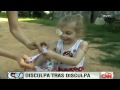 KFC expulsa a niña por cicatrices en su cara