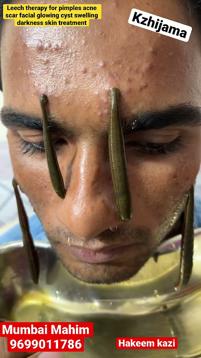 Is leech therapy good for face?      / #leechtherapy#face#acne#scar#glowingskin#youtube#short#viral