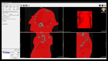 Analyze 15.0 - Segment: Using Filter Objects to Improve Segmentation