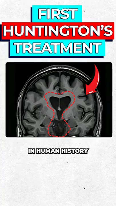 World-First Treatment for Huntington's Explained