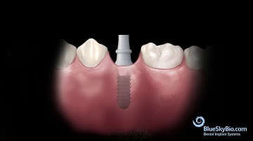 Tissue Level Implant - Blue Sky Bio