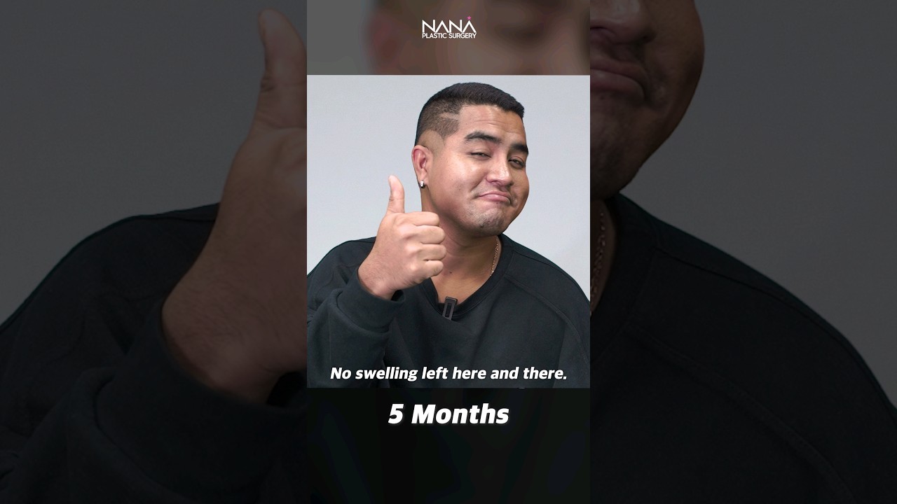 MALE FACIAL LIPOSUCTION at NANA/Amazing RESULTS