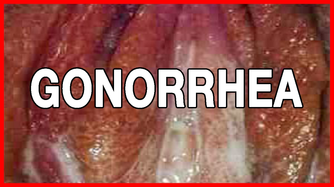 when does gonorrhea symptoms appear