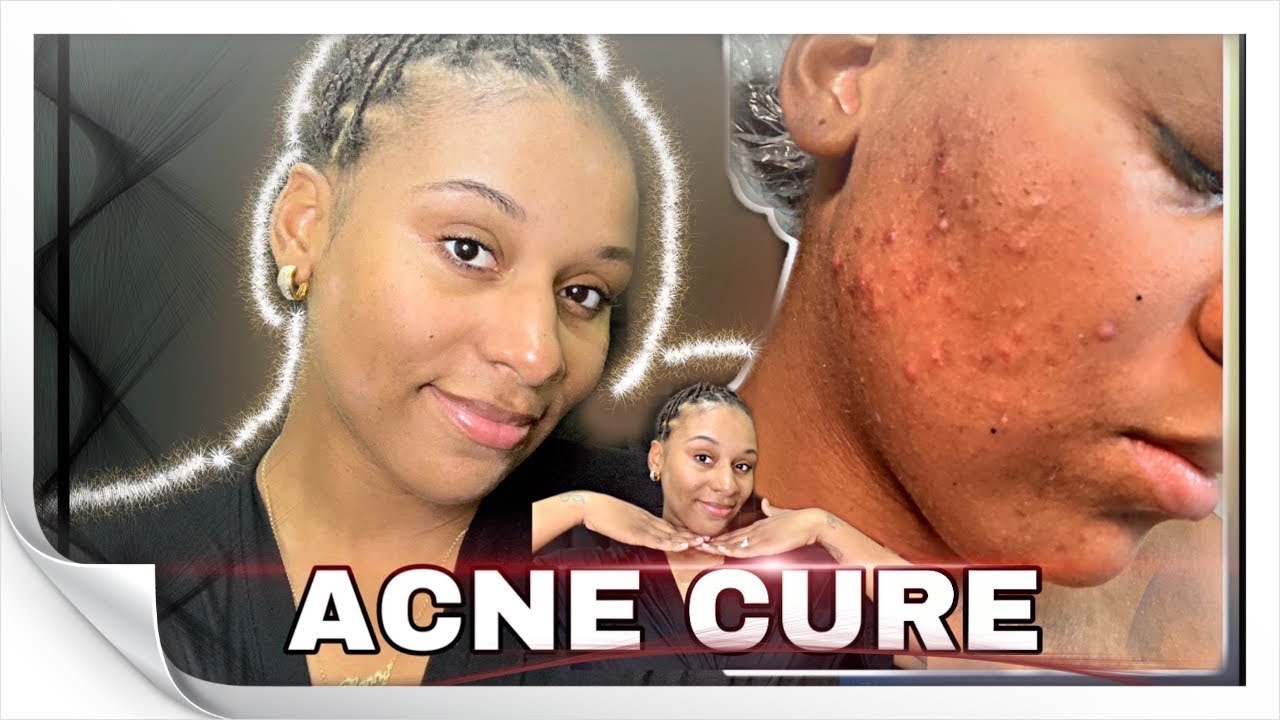 VITAMINS CURED MY ACNE FAST! NO DIET CHANGE! YouTube
