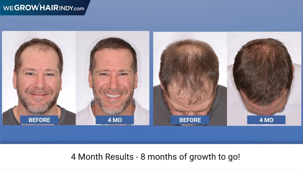 Hair Transplant Growth Timeline  Day By Day Recovery Photos