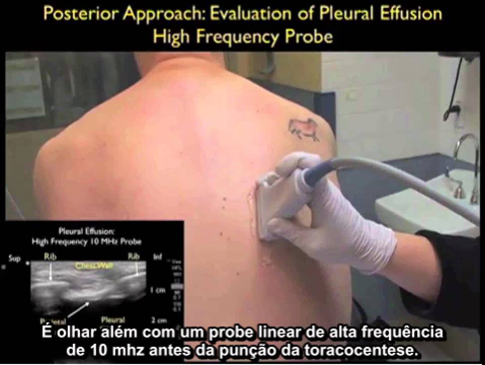 Acesso Vascular -EDU00039 Toracocentese guiada com Ultrassom SonoSite