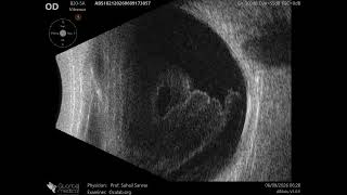 20 MHz Annular Ophthalmic Ultrasound ABSolu, Intragel hemorrhage , 37320