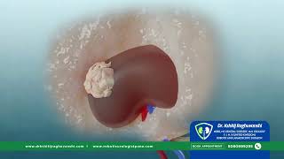 Robot assisted Partial Nephrectomy RAPN