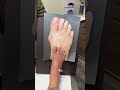 CONSIDERING BUNION SURGERY? LISTEN UP!👨🏻‍⚕️#shorts #bunionsurgery #juanetes thumbnail