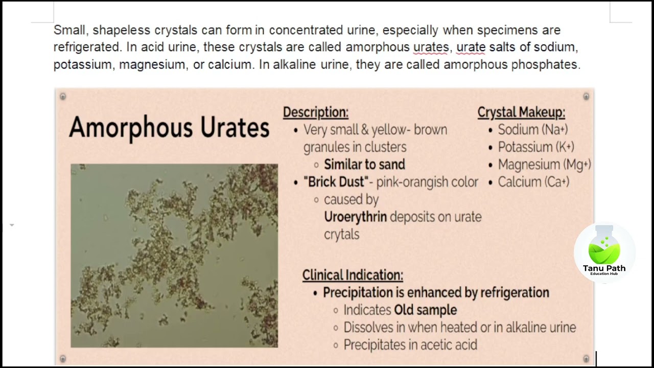 sodium urate in urine