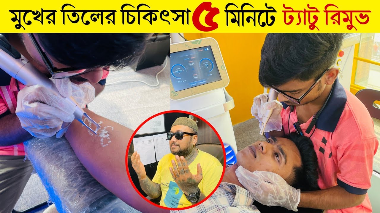 মুখের তিলের চিকিৎসা - তিলের সমাধান😱Mole on face treatment - Laser Mole Removal🔥Tatto Remove Center