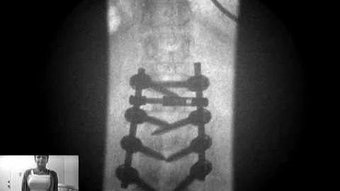Spinal Decompression| Vancouver Wa | Dr Stephen Ma...