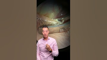 What is Meibomian Gland Expression?