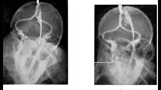 Sinography And Sinogram; radiographic technique used to evaluate sinus tracts