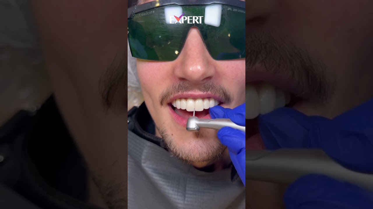 Veneer Preparation Live | Smile Design at Expert Dental Clinic Turkey