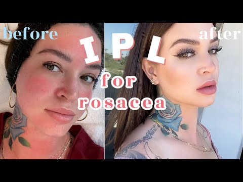 How I treat my ROSACEA !  IPL Photofacial 👼🏼 THE FACIAL THAT CHANGED MY FACE