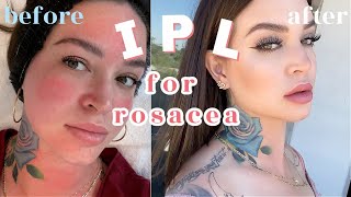 How I treat my ROSACEA !  IPL Photofacial 👼🏼 THE FACIAL THAT CHANGED MY FACE