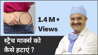 How To Remove Stretch Marks (स्ट्रैच मार्क्स को कैसे हटाएं) | ClearSkin, Pune | (In HINDI)