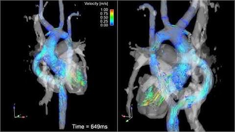 Blood Moving Through the Heart - 4D Flow