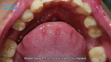 LIÊN TIẾP CÁC CASE TRỒNG RĂNG CHO NGƯỜI CAO TUỔI TẠI NHA KHOA NỤ CƯỜI VIỆT