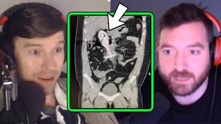 Man ACCIDENTALLY Leaves Metal Plug in During MRI
