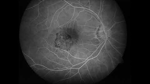 Fluorescein angiogram of Classic Choridal Neovascular membrane in wet AMD