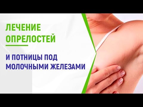 Лечение опрелостей и потницы под молочными железами