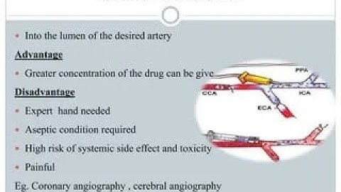 Intra Arterial Route of Drug Administration (Injection)