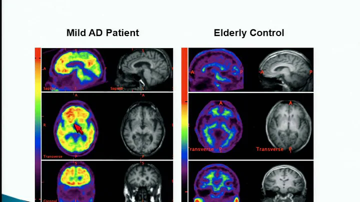 What to Expect for Brain Imaging Procedures, Eilee...