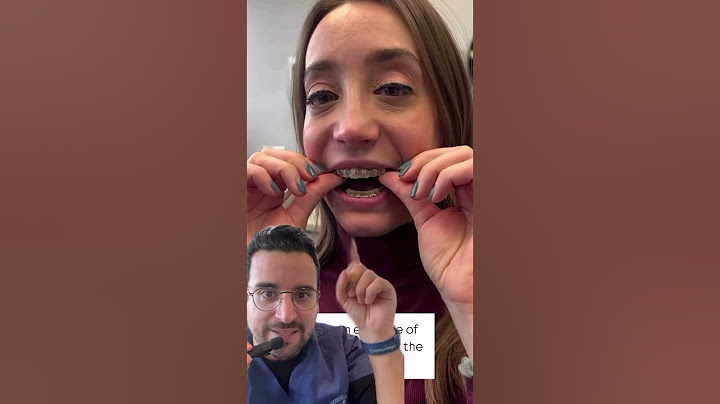 Traitement orthodontique agressif : risque pour les dents ?