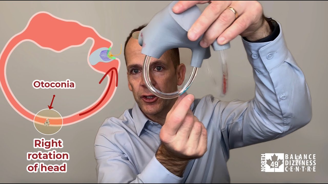 Ewald's Laws: Mastering BPPV Treatment for Atypical Cases