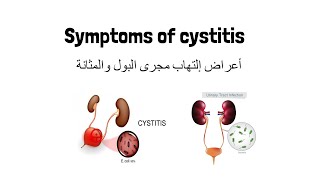 أعراض إلتهاب مجرى البول والمثانة - Cystitis