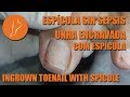 Uña encarnada - Unha encravada com espícula - Ingrown toenail with spicule [Podología Integral]
