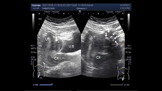 Two Fibroids, one with calcification.