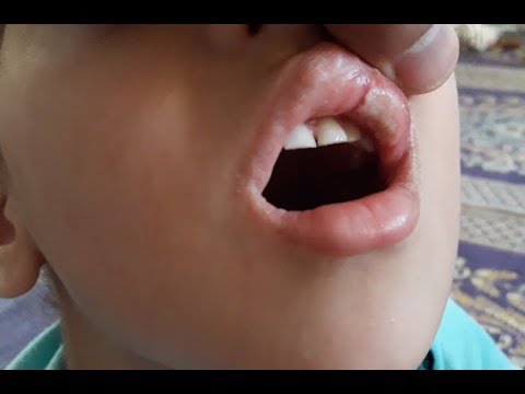 علاج التهاب الشفة والفم واللثة بطريقة فريدة