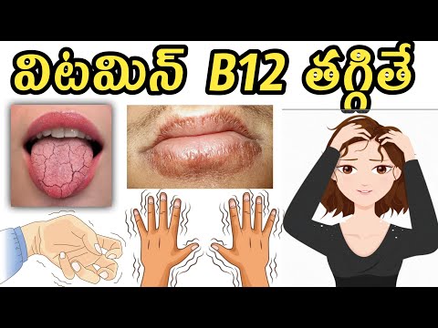 Low Vitamin B12 Symptoms in Telugu(విటమిన్ బి 12 )