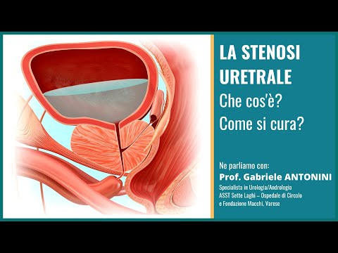 Video: Le stenosi uretrali causano dolore?