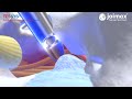 Minimally invasive treatment of herniated disc with joimax tessys in lateral position