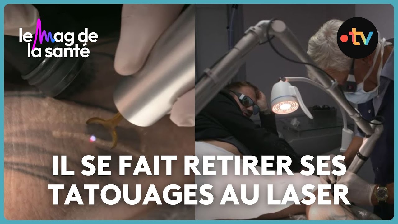 Coût, douleur, fréquence des séances : vous saurez tout sur le dé-tatouage