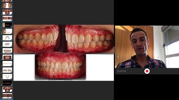 invisalign, aligners and screws to solve a severe Class II malocclusion. Invisalign course.